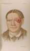 A smaller Atlas of illustrations of Clinical surgery. Jonathan Hutchinson, LL. D. , F. R. S