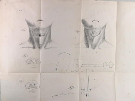 Recherches sur les maladies qui affectent les organes de la voix humaine. F. Bennati