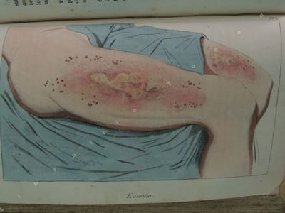 ABREGE PRATIQUE DES MALADIES DE LA PEAU d ' après les auteurs les plus estimés et surtout d ' après les documents puisés dans les leçons cliniques de M. le Docteur Biett médecin de l ' hôpital Saint-Louis