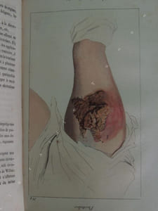 ABREGE PRATIQUE DES MALADIES DE LA PEAU d ' après les auteurs les plus estimés et surtout d ' après les documents puisés dans les leçons cliniques de M. le Docteur Biett médecin de l ' hôpital Saint-Louis