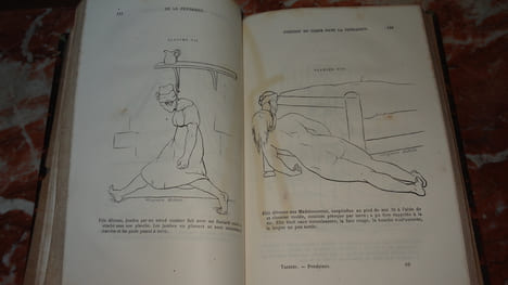 ÉTUDE MÉDICO-LÉGALE SUR LA PENDAISON, LA STRANGULATION ET LA SUFFOCATION. TARDIEU Ambroise