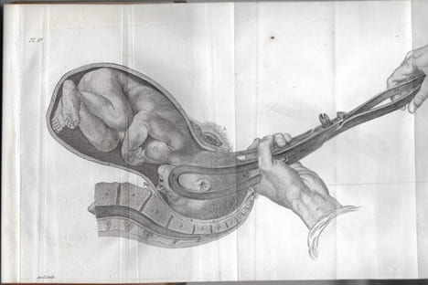 L'Art des Accouchemens. BAUDELOCQUE