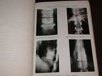 Contribution à l'Etude Des Spondylites Mélitococciques