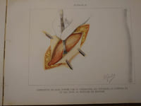 L'opération de Bassini pour la guérison radicale de la hernie inguinale avec 16 planches illustrées du peintre Orazio Gaigher, docteur en médecine.