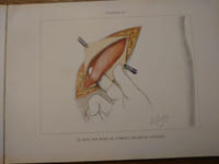 L'opération de Bassini pour la guérison radicale de la hernie inguinale avec 16 planches illustrées du peintre Orazio Gaigher, docteur en médecine.
