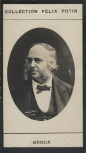 Photographie de la collection F&eacute;lix Potin (4 x 7,5 cm) repr&eacute;sentant : Paul Broca, m&eacute;decin.. BROCA (Paul) Photo Pierre Petit.
