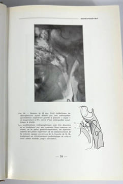 Tumeurs malignes du pharynx et du larynx. Étude anatomo-topographique et radiographique. F. Baclesse
