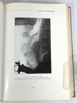 Tumeurs malignes du pharynx et du larynx. Étude anatomo-topographique et radiographique. F. Baclesse