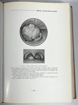 Tumeurs malignes du pharynx et du larynx. Étude anatomo-topographique et radiographique. F. Baclesse