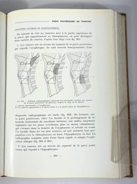 Tumeurs malignes du pharynx et du larynx. Étude anatomo-topographique et radiographique. F. Baclesse
