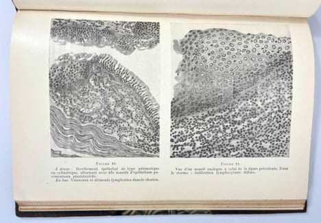 Le tractus thyréoglosse. Embryologie topogographique, pathologie chirurgicale, kystes, fistules et tumeurs. G. Rémy Néris