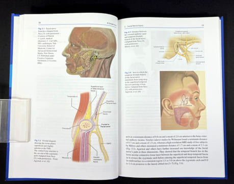 Complications of Temporomandibular Joint Surgery. Gary F. Bouloux (ed.)