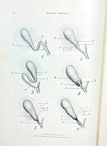 Chirurgie des voies biliaires