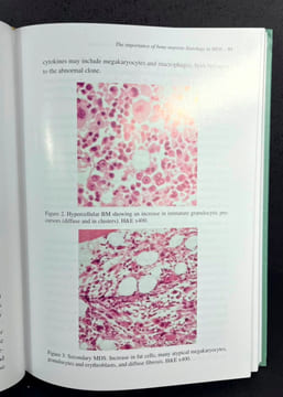 Myelodysplastic and Myeloproliferative Disorders in Childen. Luiz Fernando Lopes, Henrik Hasle (eds)