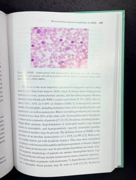 Myelodysplastic and Myeloproliferative Disorders in Childen. Luiz Fernando Lopes, Henrik Hasle (eds)