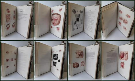 ATLAS pour l'Iconographie ophthalmologique ou description, avec figures coloriées, des maladies de l’organe de la vue comprenant l’anatomie ...