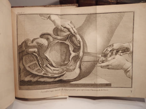 Mémoires de l'Académie de Chirurgie. Tomes 1 à 5.. LA PEYRONIE, QUESNAY, PETIT, DU FOUART, LA FAYE, GARENGEOT, FOUBERT, LA MARTINIERE, LOUIS, ...