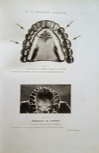 Dentures et Dentiers complets.