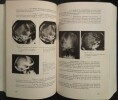 Les paralysies oculo-motrices et les déficits oculo-moteurs (Paralysies Supra-Nucléaires Exceptées).. HULLO (A.)