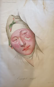 Traité complet des maladies de la peau.