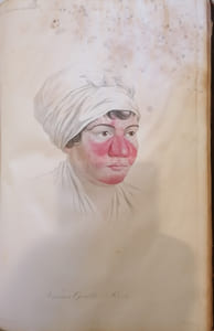Traité complet des maladies de la peau.