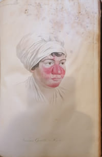 Traité complet des maladies de la peau.